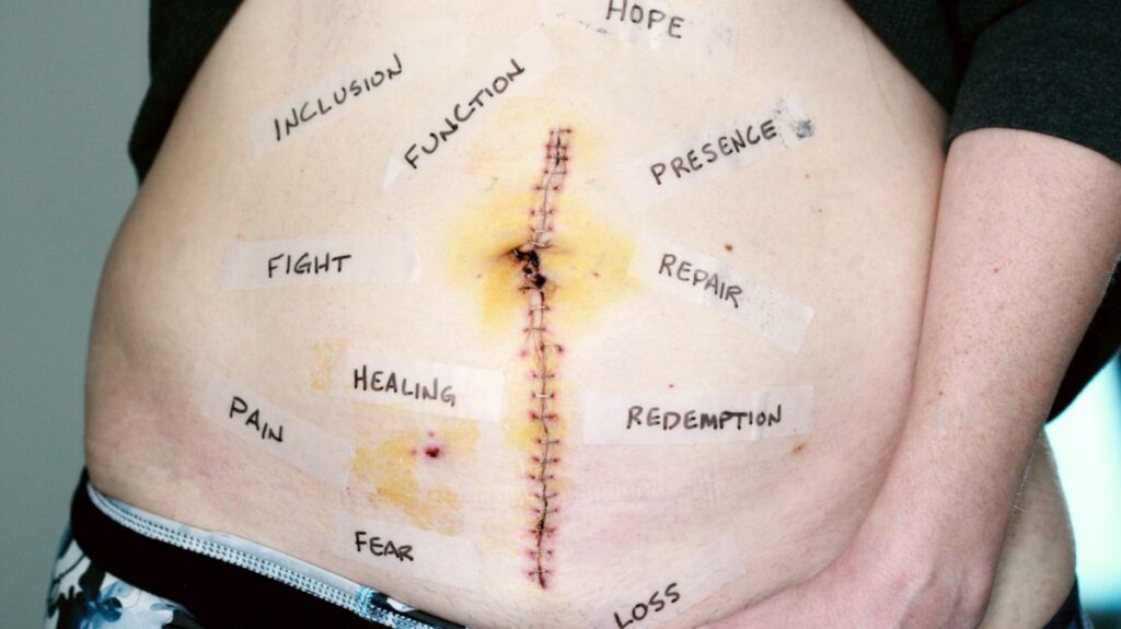 A person who has lifted their shirt up, revealing their belly which has a large vertical scar running down it (surgeon's stitches still visible). Around this they have put transparent tape on their stomach with words such as "Hope" and "Inclusion" and "healing" and "pain" and "loss" and "repair" and "redemption".